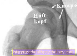 Vzroki kolčnega osteoartritisa