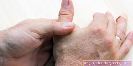 ¿Qué es la artritis en silla de montar del pulgar?