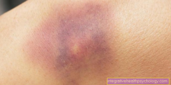 Duration of a bruise