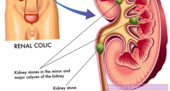 Ureteral stone