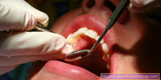 Enfermedad periodontal ulcerosa necrosante aguda