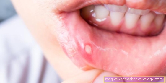 Aphthae - What Causes Small Blisters In The Mouth?