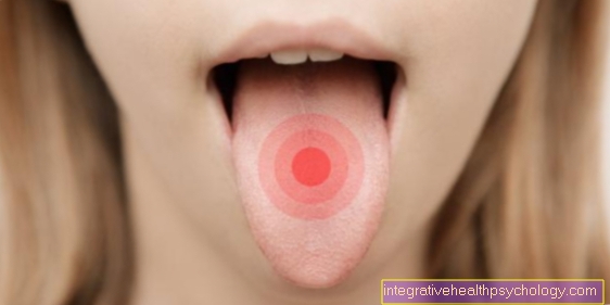 Canker lở loét trên lưỡi