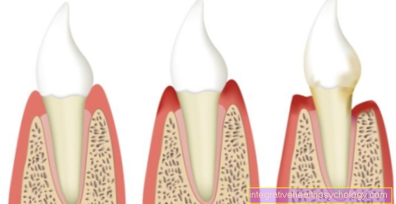 Kronisk periodontal sjukdom