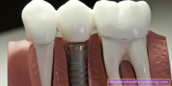 The dental implant