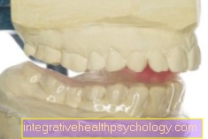 Materiales de una férula oclusal