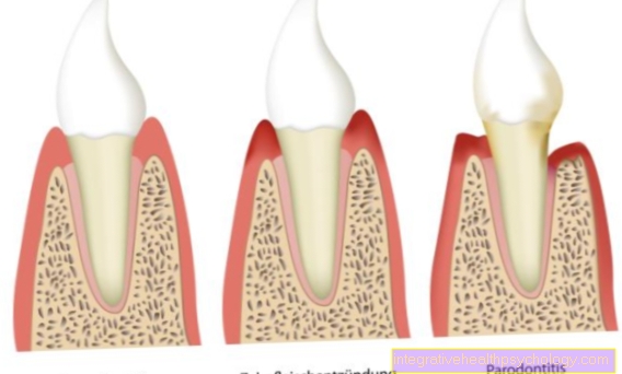 Periodontal sygdom og periodontal sygdom