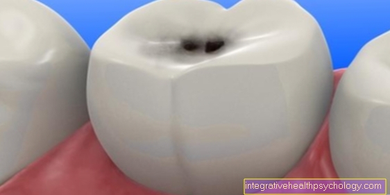 Los síntomas de la caries dental