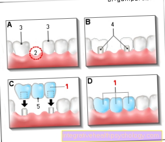 Dental bridge som en tandprotese