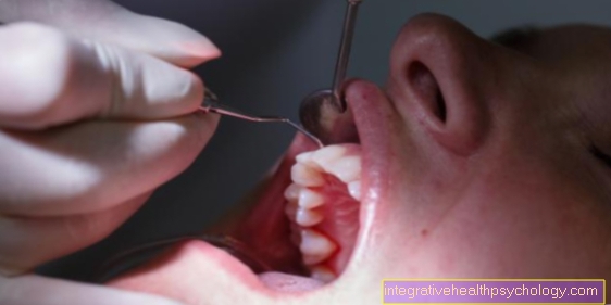 Bleeding gums as a sign of HIV infection